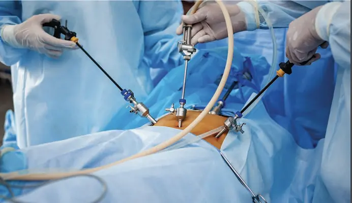 Hasil gambar untuk laparoscopic surgery
