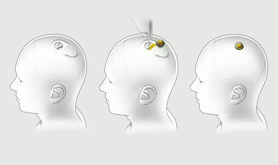 Chip Neuralink ditanamkan ke otak babi