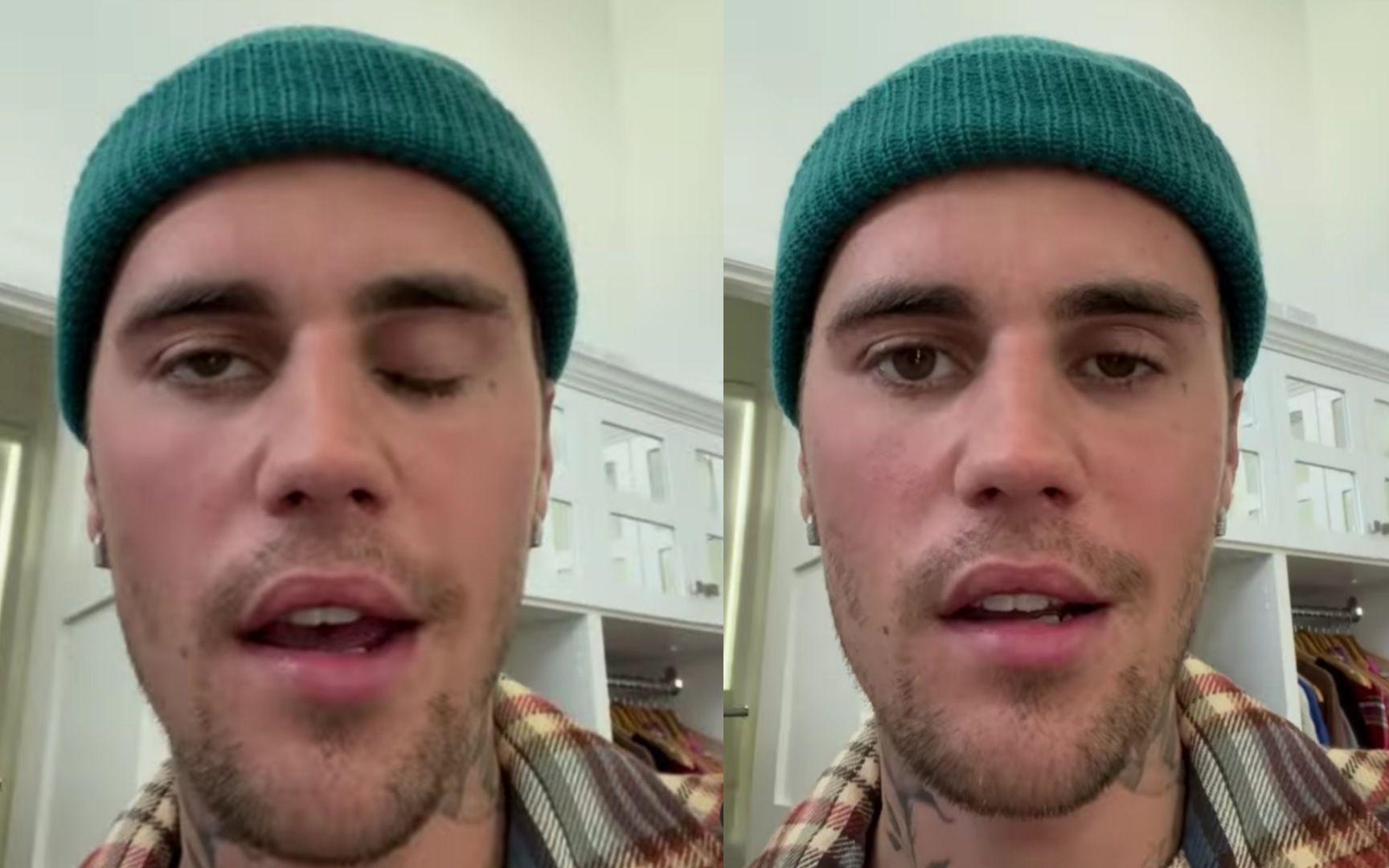 Justin Bieber Alami Ramsay Hunt Syndrome, Ini Penjelasannya Teknologi