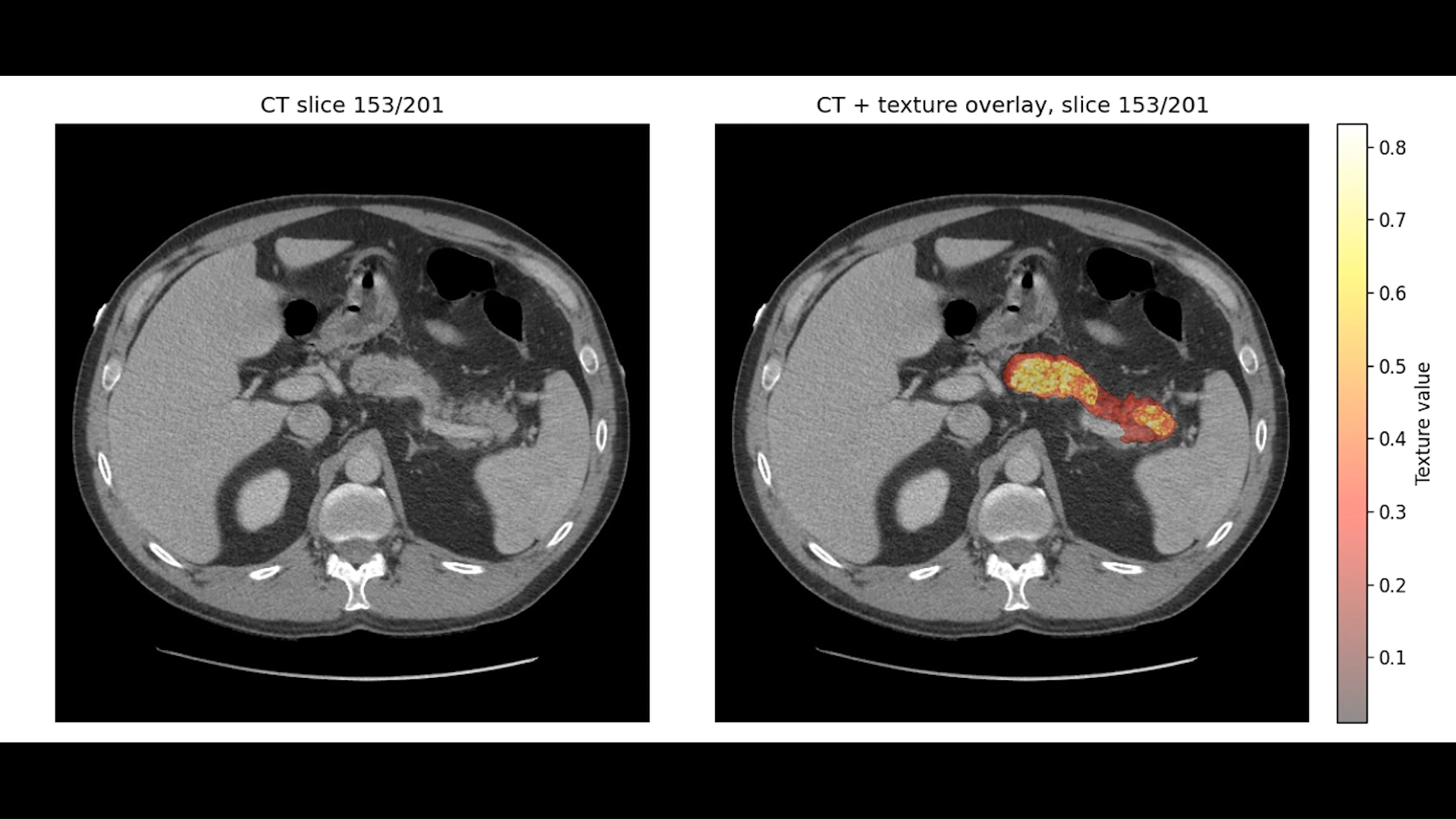 AI kanker pankreas, deteksi dini kanker, Mayo Clinic REDMOD, teknologi medis AI, CT scan kanker pankreas